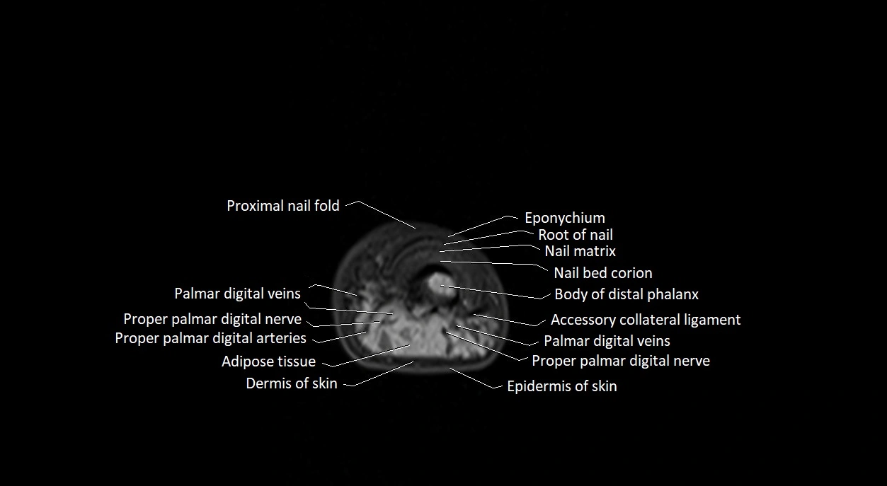 Finger anatomy axial cross sectional 3T image image 4.webp